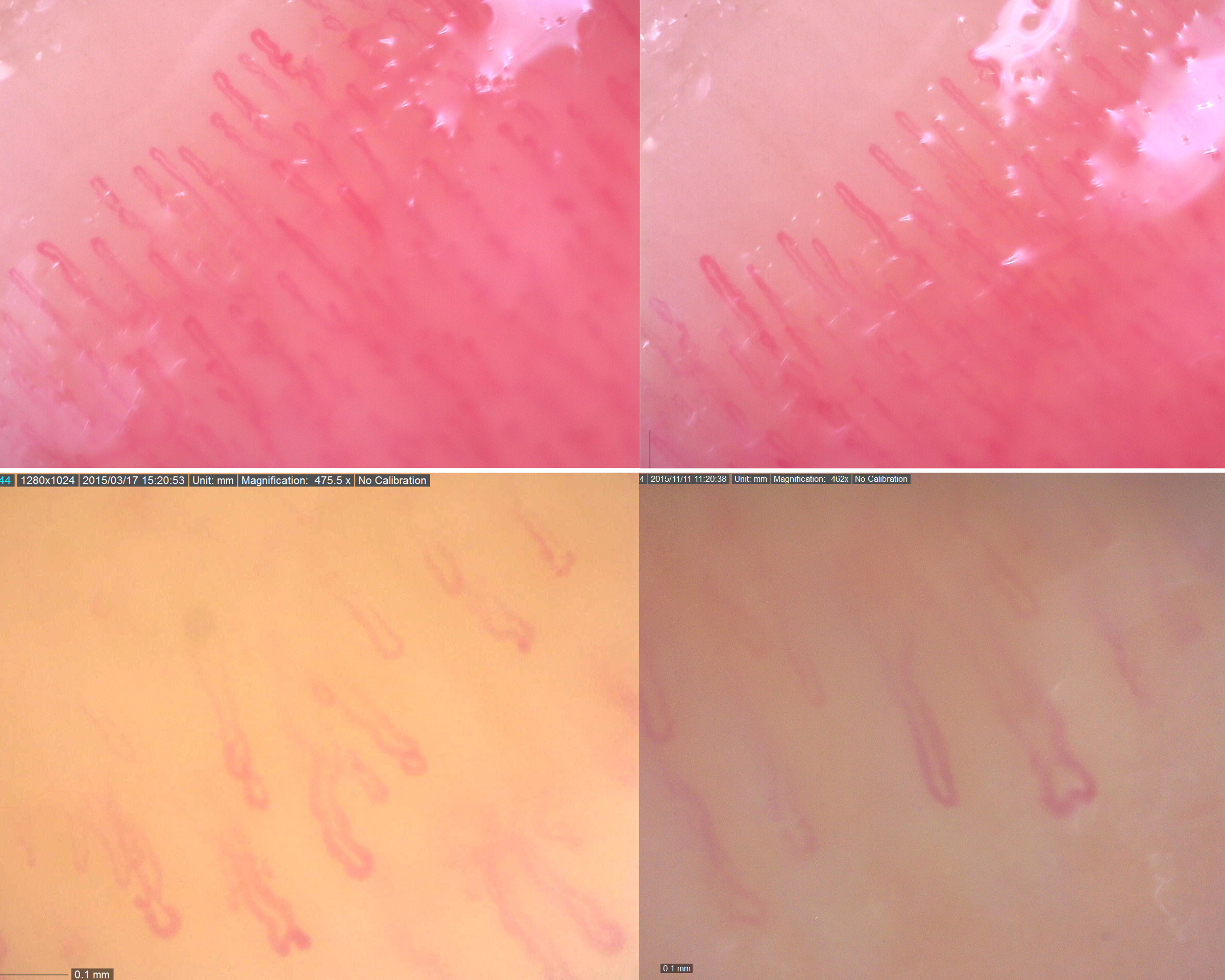 Sample images of microvasculopathy viewing capillaries with a Dino-Lite Capillaroscope to identify various connective tissue diseases