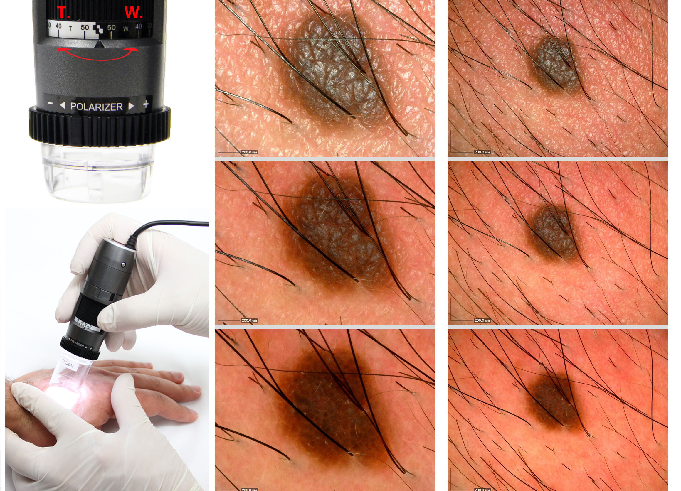 Evaluating benign and malignant skin lesions with dermascopy