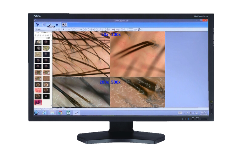 Trichoscopy results compared with Dino-Lite scopes DinoCapture software for Windows